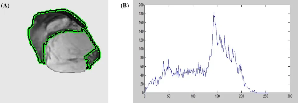 Figure III: (A) Tumor contour calculated by the proposed method on a sample MRI; (B) MRI intensity histogram 
