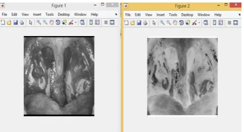Figure 8. (a):   Gabor Filter Results for Diseased Tonsils (a) Input Tonsils Image (b) Gabor Filtered output 