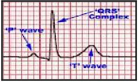 Figure 1  ECG Waveform 