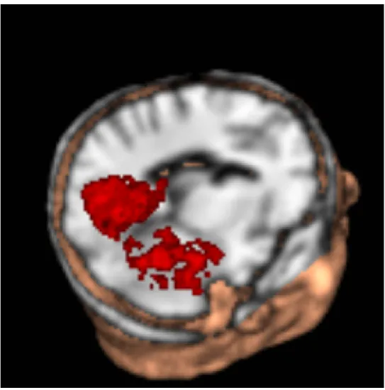Figure 4: A cutout from the anatomical fMRI volume of a subject, voxels from the ventral temporal cortex are colored red