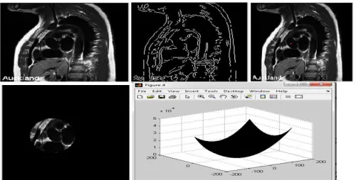 Figure 5. a)Coronal original image b) Edge detection using canny method c) Hough circle d) Segmented image  e) 3D view of segmented image 