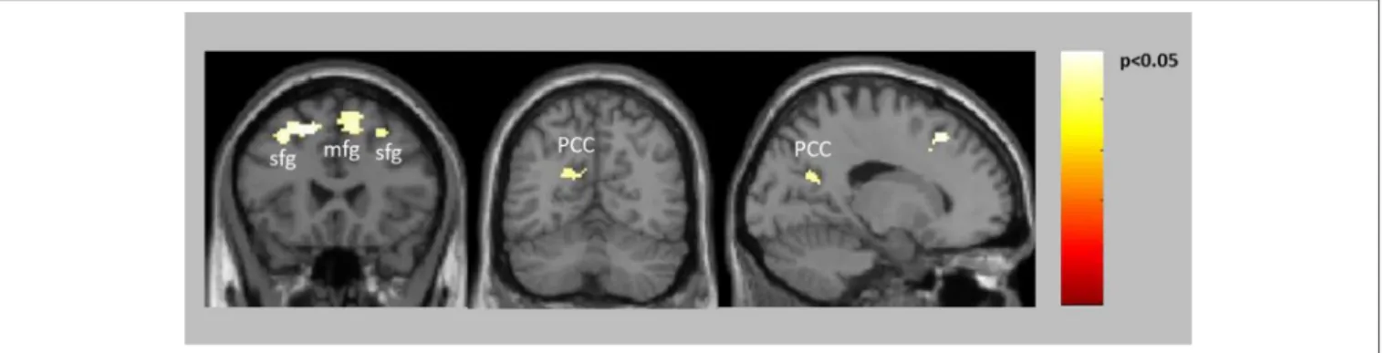 FIGURE 2 | Decreased activation in patients compared to controls for positive feedback/reward (see also Table 2).