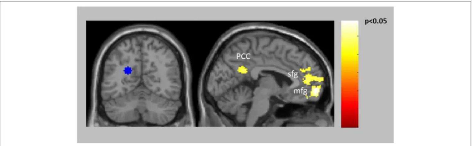 FIGURE 3 | Increased connectivity in patients compared to controls between the left PCC/precuneus (BA31) seed (blue) and left vmPFC (BA10) as well as right PCC (BA31).