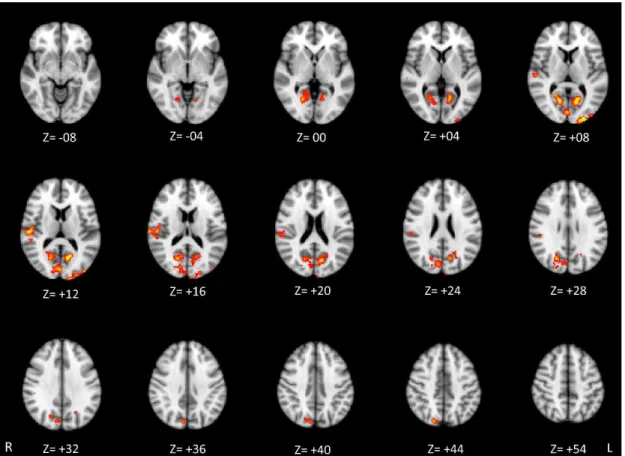 Figure 3 shows the image results of the voxel-wise statistical analysis. The figure  shows the regions demonstrating statistically significant difference (p<0.01) in functional  connectivity from the piriform cortex between patients and the control grou