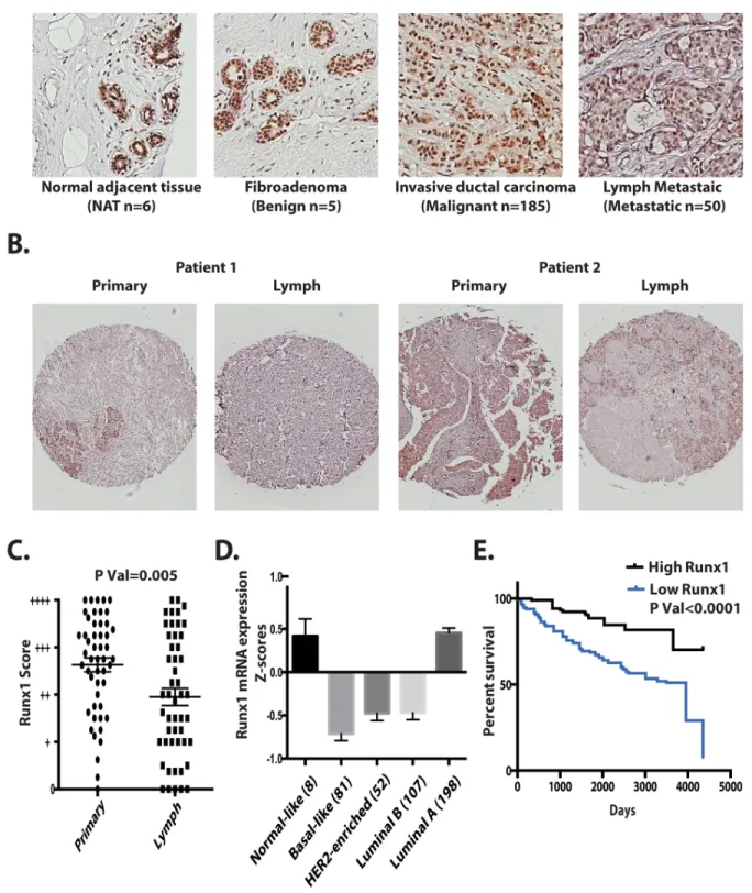 Figure 8: Runx1 expression in breast tumors correlates with metastasis, tumor subtype and survival