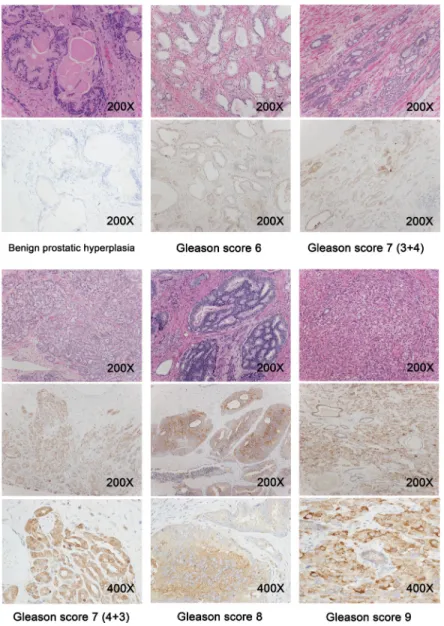 Figure 2: Prostate tissue sections were obtained from benign prostatic hyperplasia patients (n = 31) and prostate  cancer patients with a Gleason score of 6 to 9 (n = 129), and representative immunohistochemistry images are shown.