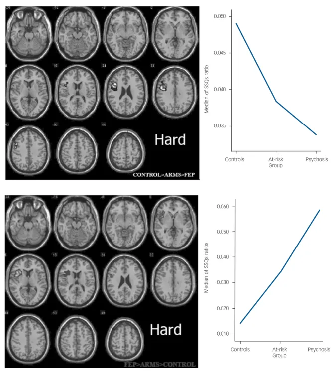 Fig. 3 Group differences in cluster activation during ‘hard’ verbal fluency. When the task demands were high, there was differential engagement of dorsolateral prefrontal cortex activation was greatest in the control group, weakest in the psychosis group, 
