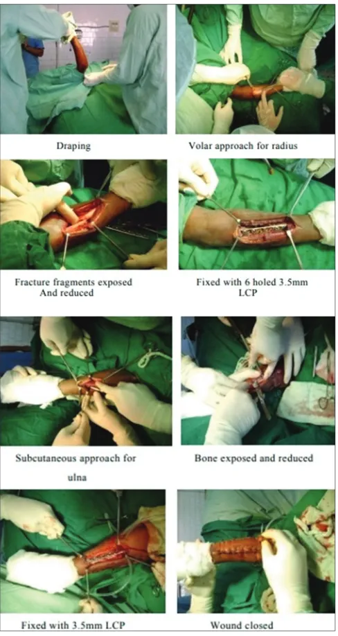 Fig. 1: Various steps of surgical technique used in fixing forearm fracture