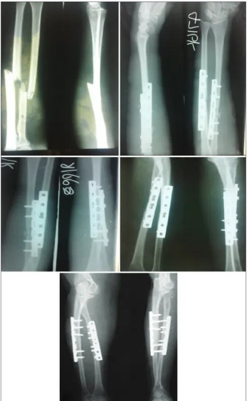 Fig. 2: Radiological images showing a fracture in the pre-
