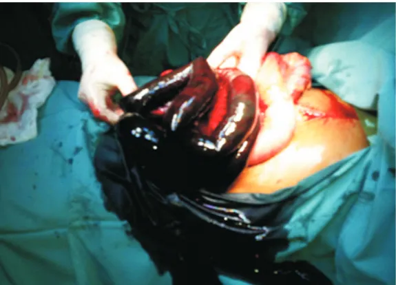 Figure 1 showing gangrenous jejunum.