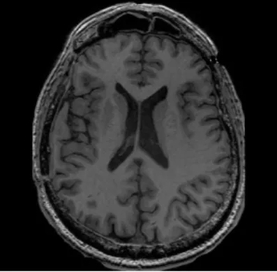Figure 5:T1 weighted brain MRI normal image  Based on the above idea the following Stepshas been developed: 
