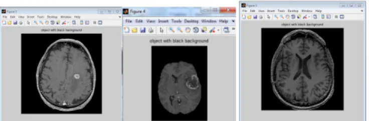 Figure 9: Approx skull area of Figure 3, Figure 4  and Figure 5  Step3: Computation of maximum peak of the histogram 