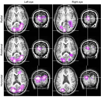 Figure 4. SAM images (n = 1) showing similar regions of activity irrespective of viewing eye or pattern type
