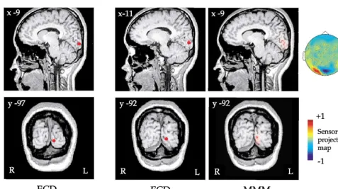 Fig. 3. Dipole source solutions to the responses evoked using a chromatic grating during the condition whereby attention was directed towardthe stimulus, coregistered with sagittal and coronal MR images for observer TK