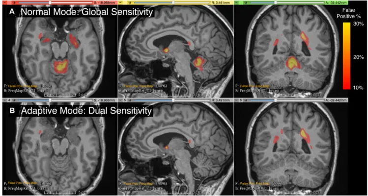 Fig 2. Frequency map of false positives from 20 randomly selected subjects, overlaid on the T1 of a single subject selected as reference