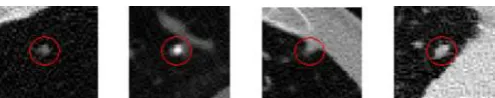 Fig -1: Transaxial CT images with the four types of nodules, shown from left to right, well-circumscribed, vascularized, juxta-pleural, and pleural-tail