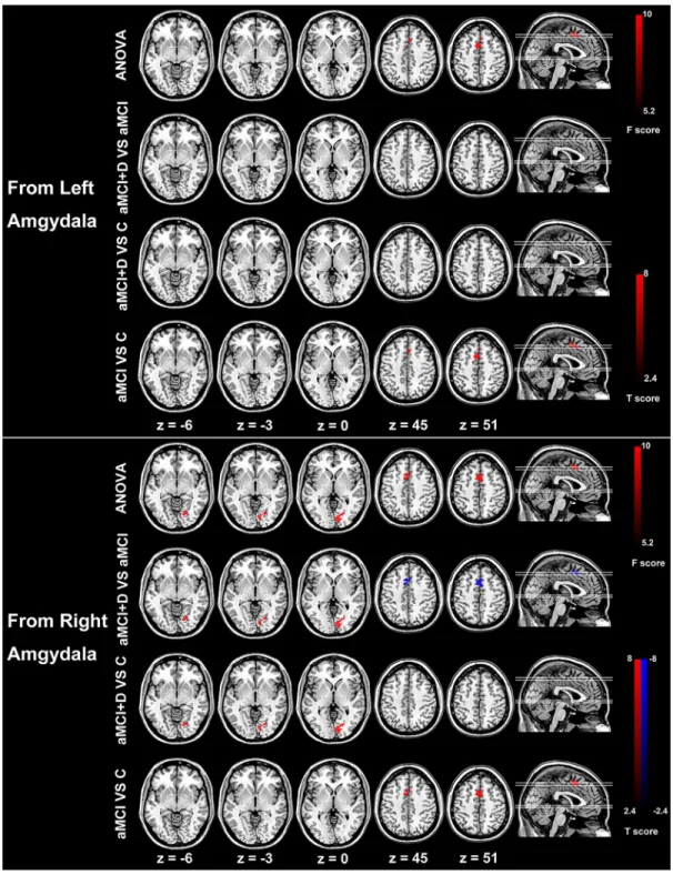 Figure 1: Group differences of effective connectivity based on the seed of right and left amygdala