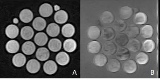FIGURE 10 A. AN MR IMAGE USED TO CALCULATE T1 TIMES, THICKNESS 3 MM, TR 1500 MS; B. AN MR IMAGE USED TO CALCULATE T2 TIMES, THICKNESS 3 MM, TR 2500 MS, TE 90 MS 