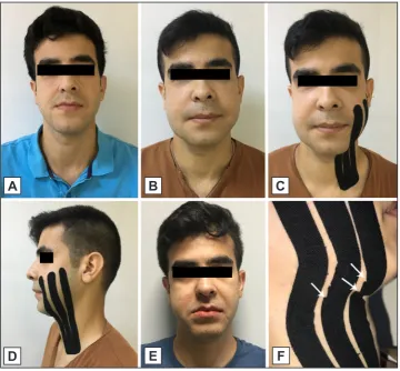 Figure 3. Preoperative view of the patient (A). The tapes were changed at postoperative day 2 to perform a face scan with 3dMD Face System for the assessment of swelling