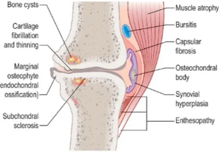Figure 1: Schematic illustration of changes in osteoarthritis.[7]