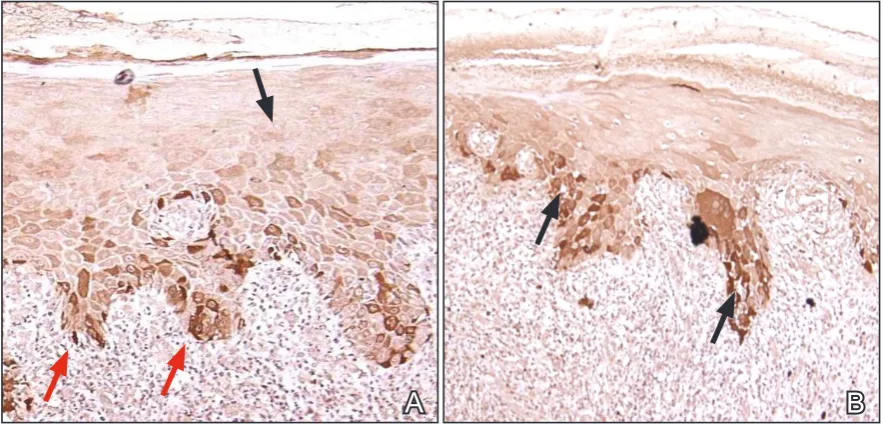 Figure 1. A = cdk4 expression in OLP; dense nuclear and cytoplasmic staining in all layers of the epithelium