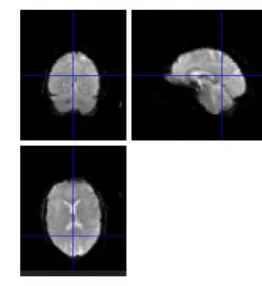 Figure 2.3 Coregistration, aligning the functional MRI data with structural image . 