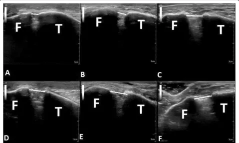 Fig. 3 Ultrasound imaging of the tibiofibular clear space at 10 Nm of external rotational torque