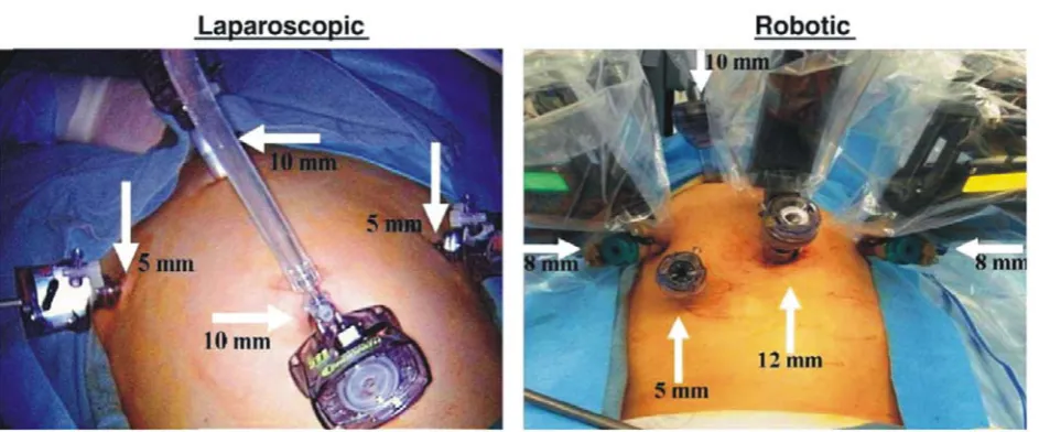 Figure 1. The comparison of conventional laparoscopy and robotic laparoscopy.20