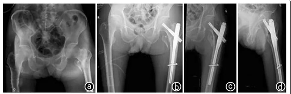 Table 3 Postoperative complications of PFNA and CPH in treating intertrochanteric fractures in elderly [n(%)]