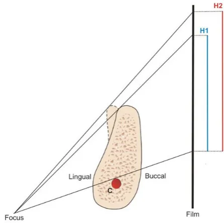 Figure 2. A = Thin crestal ridge was reduced to create wide recipient bed for planned implant installation