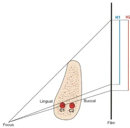 Figure 4. The position of mandibular canal (C1 and C2) in horizontal plane influences the apparent height (H1 and H2) of bone available for implant accommodation.