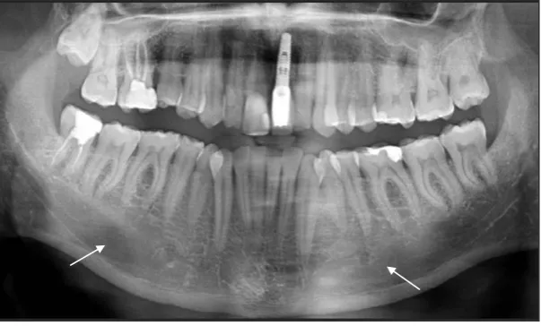 Figure 5. The orthopantomograph shows the disrupted (arrows) superior border of mandibular canal and cancellous bone which has few and thin trabecullae.