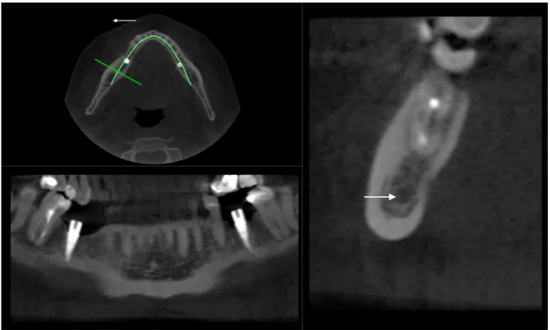 Figure 6 A. Computed tomographic images: mental foramen (arrow) detection.