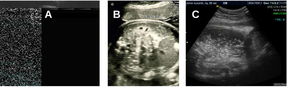 Table 2. Brief summary of the differentiation among fetal ascites, meconium peritonitis and ruptured of cystic teratoma based onprenatal sonographic appearance.