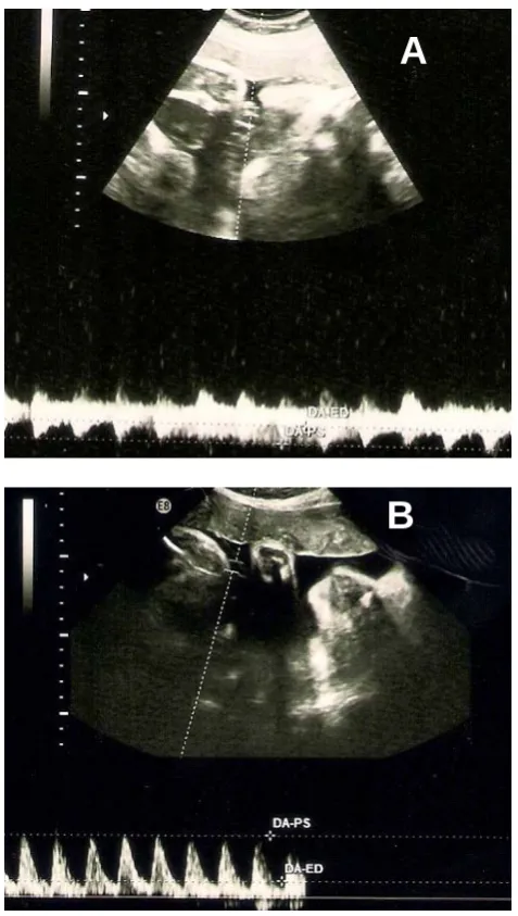 Figure 1: A. Intra abdominal free fluid with increased echo- genicity (meconium ascites), and intra-abdominal