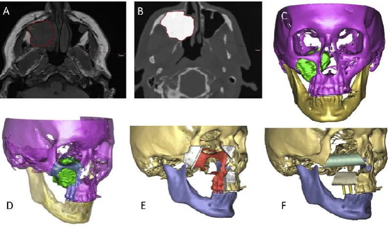 Figure 2 Impression of the currently used UMCG planning workflow (images from Kraeima et al