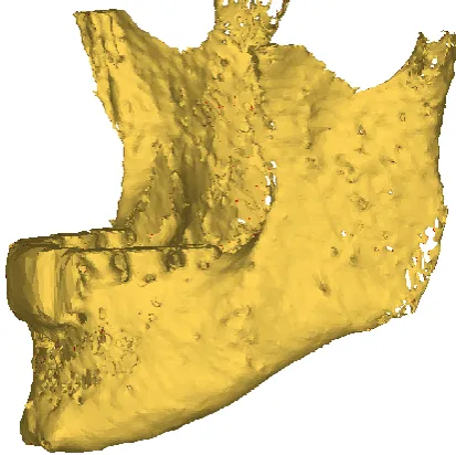 Figure 4 Impaired segmentation quality of the mental region showed in axial and sagittal slices and the 3D model derived from the standard black bone MRI sequence of the test series with a flip angle of 2˚