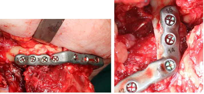Figure 9 Virtual surgical plan of first case (left) and second case (right) showing the 3D MRI-based mandible models (white), fibula segments (green and blue), patient specific reconstruction plate (grey, left case) and the cutting guides (yellow, right ca