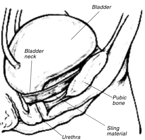 Gambar 3. Sling procedure1