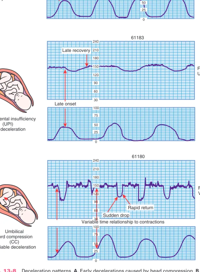 Fig. 13-8 Deceleration patterns. A, Early decelerations caused by head compression. B, Late decelerations caused by uteroplacental insufficiency