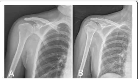 Fig. 1 Radiographic findings of occult surgical neck fracture in apatient. a Isolated GT fracture was diagnosed from the radiographon day 1