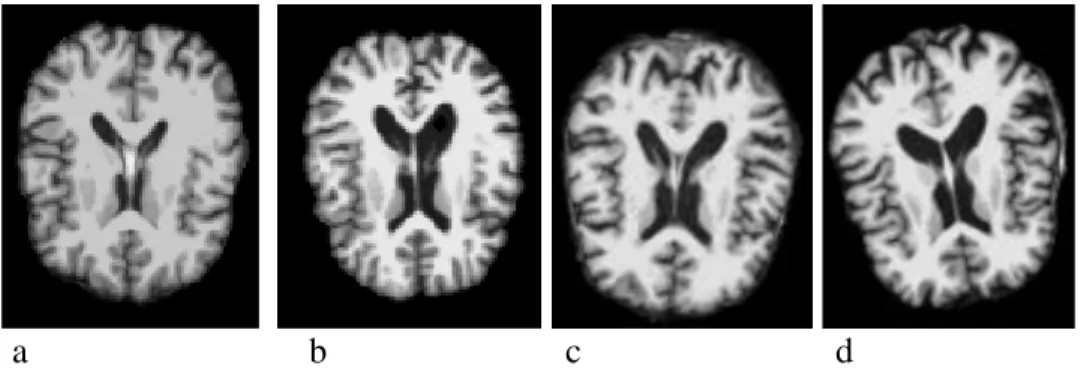 Figure 3.3 Classification is achieved by either detecting disease vs normal or by classifying  the disease at different stages based on an input image normally a T1-MRI or FDG-PET scan