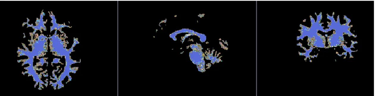 Figure 3.4 Example of OASIS-3 dataset with ground truth of white matter segmentation. 
