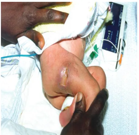 Figure 1c: The same child 2 months later. All figures  from Dreyfus M, Masterson M, David M, et al 1995