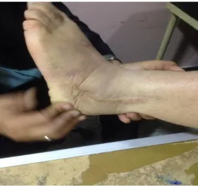 Figure (7) 6 months post-operative scar. 