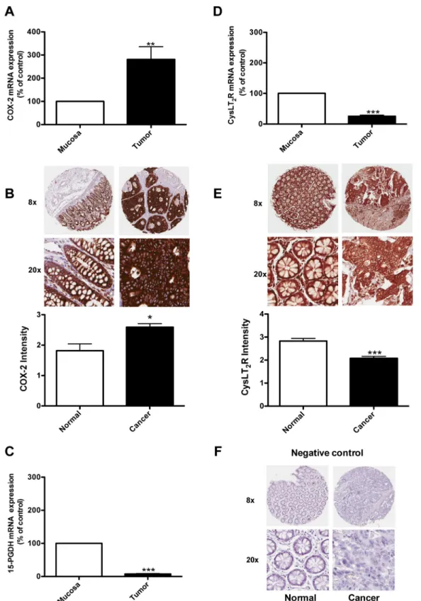 Figure 1: Expression of COX-2, 15-PGDH, and the CysLT 2  receptor in colon cancer patients