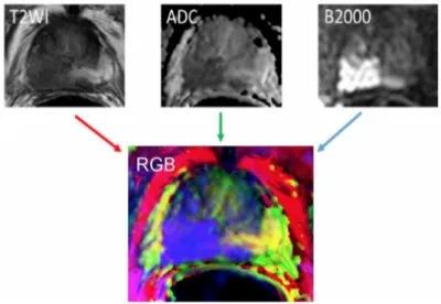 Figure 5: Generating a three­channel RGB image from three mp­MRIs [ Tsehay et al., 2017 ]. 