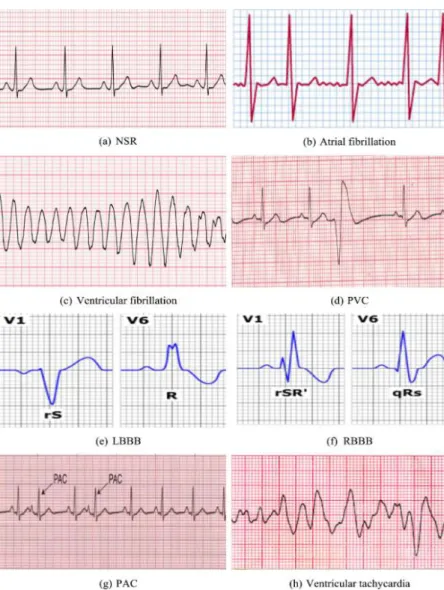 Figure 1-3 Types of arrhythmia and Normal ECG signal (Sahoo, S et al. 2020) 