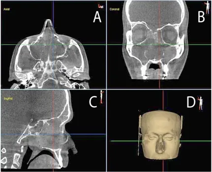 Fig. 1. Axial (A), coronal (B), sagittal (C) and 3D re-construction of the images acquired using  CBCT of a patient with polyposis and chronic rhinosinusitis 