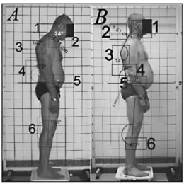 Figure 9: Visual Reference for Posture Evaluation. Showing a person with a depres-sive episode and during remission